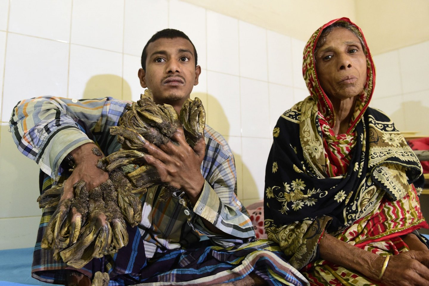 Abul Bajandar (L), 26, dubbed "Tree Man" for massive bark-like warts on his hands and feet, sits at Dhaka Medical College Hospital in Dhaka on January 31, 2016. A Bangladeshi autodriver dubbed "Tree Man" for massive bark-like warts on his hands and feet will finally have surgery to remove the growths that first appeared 10 years ago, a hospital said on January 31, 2016. The massive warts, which first started appearing when he was a teenager but began spreading rapidly four years ago, have been diagnosed as epidermodysplasia verruciformis, an extremely rare genetic skin disease that makes the person vulnerable to warts. AFP Photo/ Munir uz ZAMAN / AFP / MUNIR UZ ZAMAN (Photo credit should read MUNIR UZ ZAMAN/AFP/Getty Images)