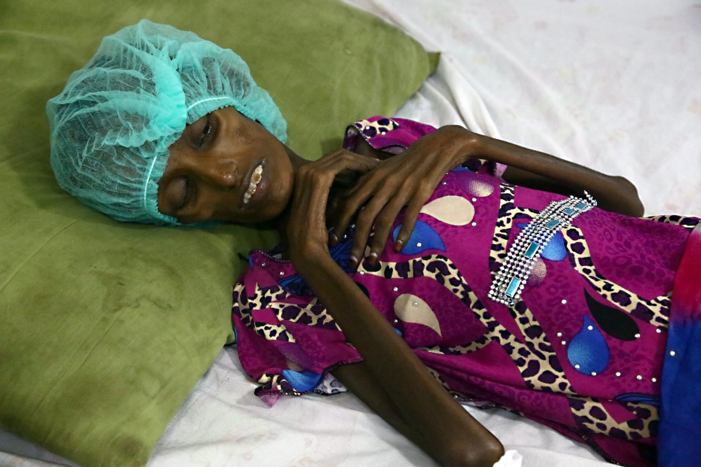 Saida Ahmad Baghili, an 18-year-old Yemeni woman from an impoverished coastal village on the outskirts of the rebel-held Yemeni port city of Hodeida, where malnutrition has hit the population hard, lies in a bed at the al-Thawra hospital in Hodeidah where she is receiving treatment for severe malnutrition on October 25, 2016. The UN's children agency UNICEF estimates that three million people are in need of immediate food supplies in Yemen, while 1.5 million children suffer from malnutrition. / AFP / STRINGER (Photo credit should read STRINGER/AFP/Getty Images)